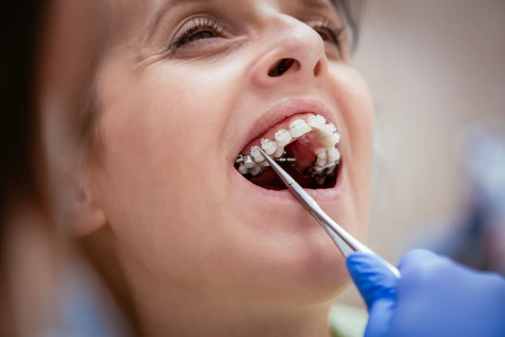 Clear braces consultation at Shining Smiles Orthodontics in Irvine CA