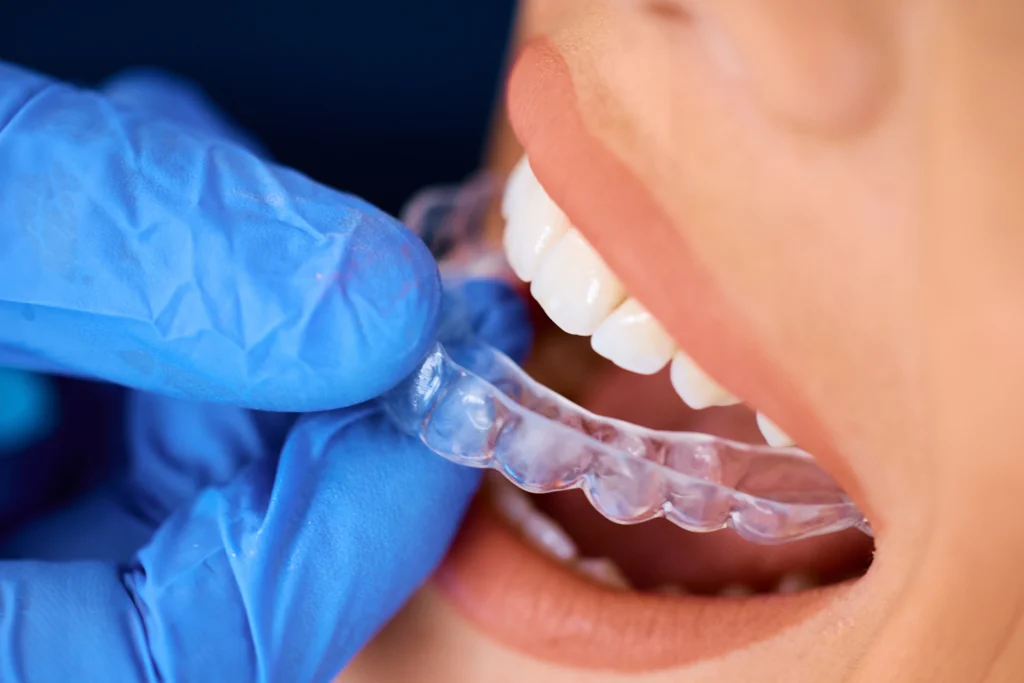 someone putting in a clear aligner invisalign alternative tray at shining smiles orthodontics in irvine ca