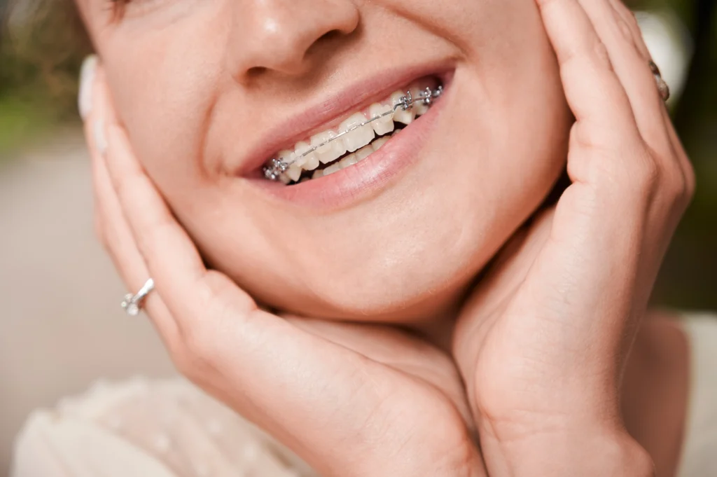 Patient smiling with clear ceramic braces in Irvine CA